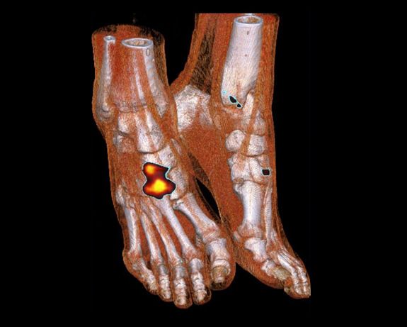 Scintigraphie osseuse du pied - Arthrose
