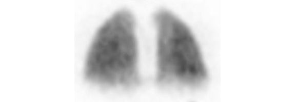 Scintigraphie pulmonaire 