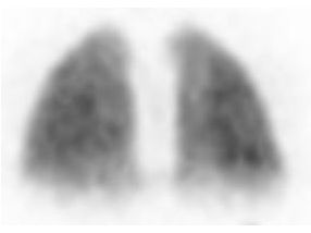 Scintigraphie pulmonaire