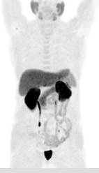 TEP-Choline et prostate