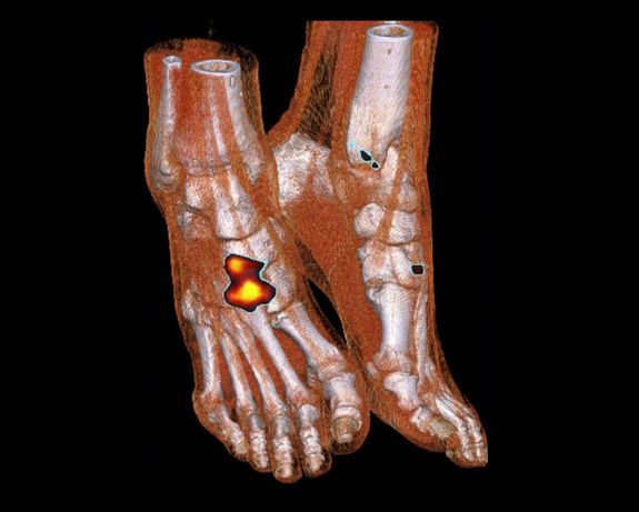 Scintigraphie osseuse du pied - Arthrose Scintigraphie osseuse du pied - Arthrose