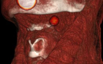 Ganglion sentinelle en ORL