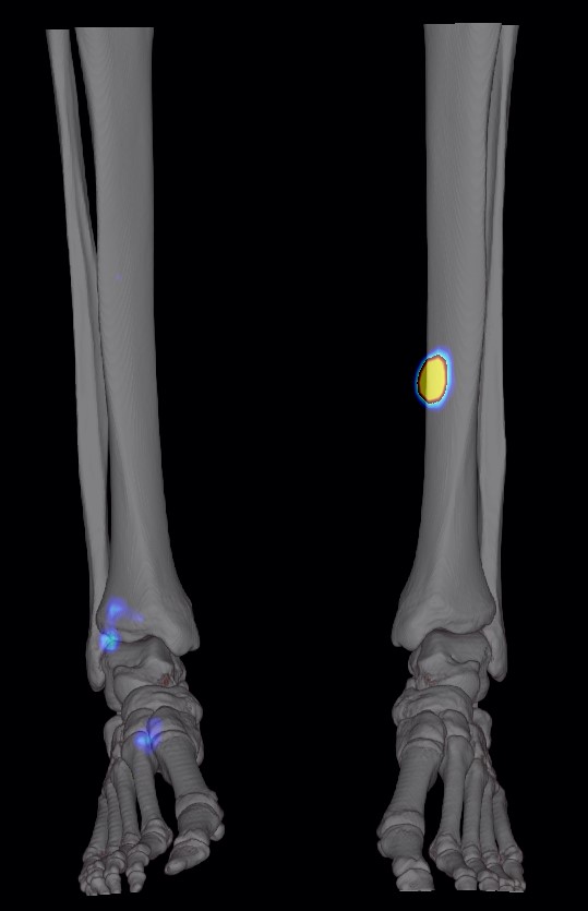 Fracture-contrainte