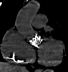 Endocardite sur valve aortique mécanique 2