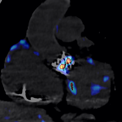 Endocardite sur valve aortique mécanique 3