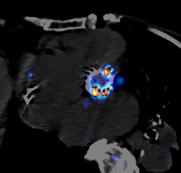 Endocardite sur valve aortique mécanique 4
