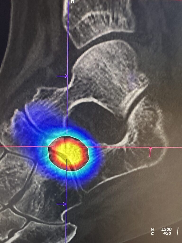 Fracture du Rostre du calcaneum