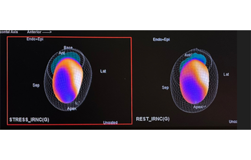 perfusion myocardique