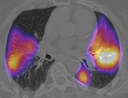 scinti-scanner pulmonaire
