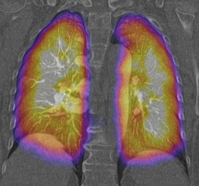 scinti-scanner pulmonaire