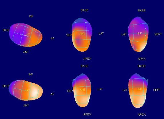 scintigraphie perfusion myocardique