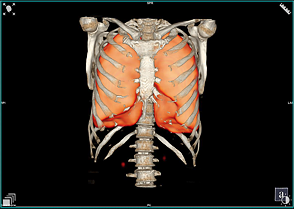 scintigraphie pulmonaire 