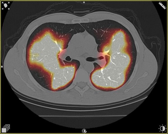 scintigraphie pulmonaire