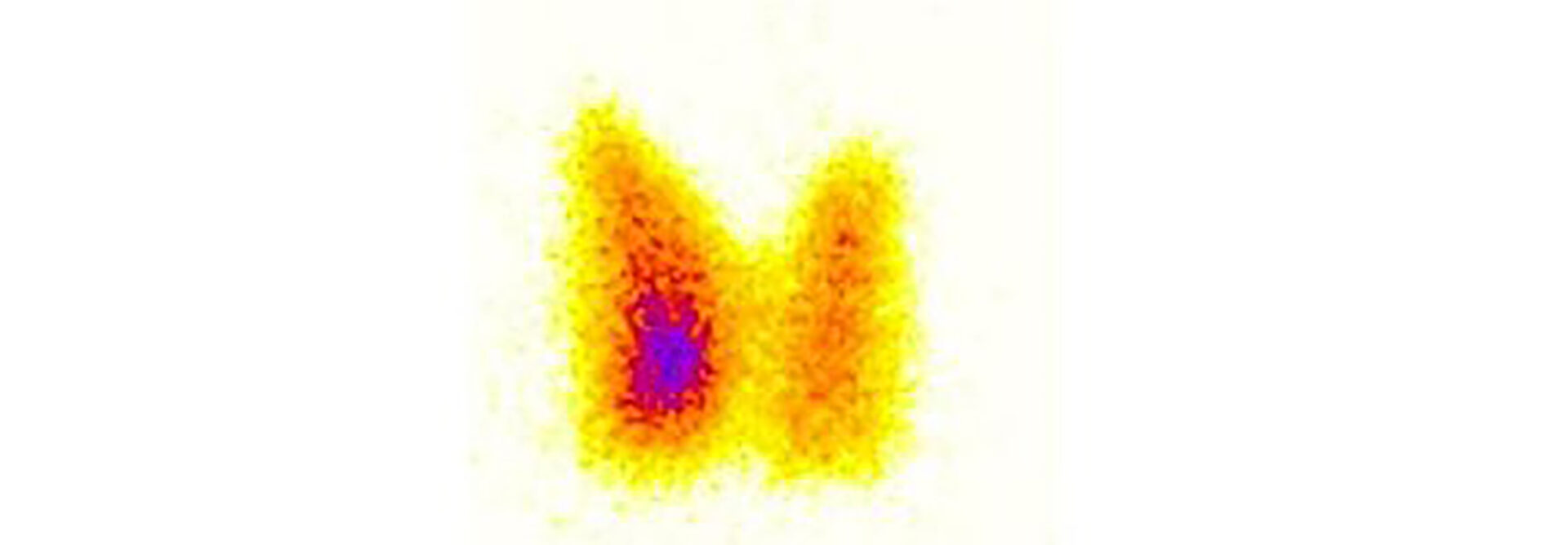 scintigraphie thyroidienne