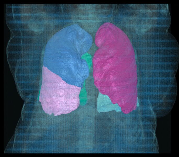 Imagerie médecine nucléaire CEI - Poumons