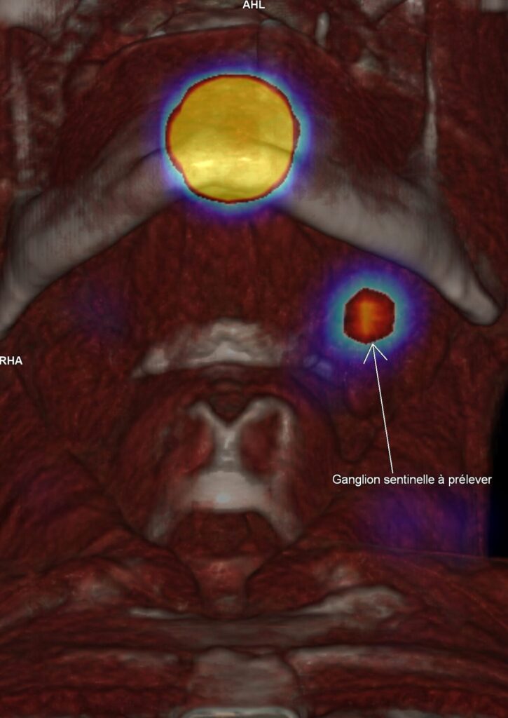 Ganglion sentinelle en ORL